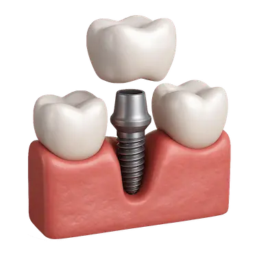 Corona dental sobre implante de titanio con encía rosada y diente blanco en diseño 3D CADCAM