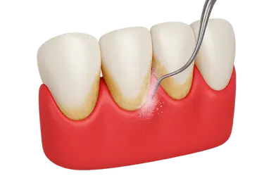 Instrumento dental realizando curetaje para eliminar sarro bajo la encía