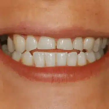 Desgaste de los dientes observado antes de indicar una férula dental
