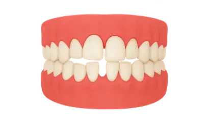 Diastema cerrado mediante Invisalign en la clínica del Dr. Ferrer