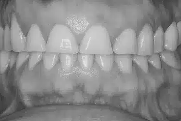 Desgaste dental con bordes astillados causado por bruxismo