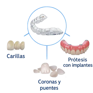 Férula dental para proteger carillas, coronas, puentes y prótesis