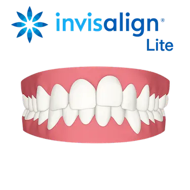 Invisalign Lite en Madrid con el Dr. Ferrer para ortodoncia invisible en casos leves y moderados