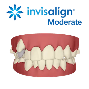 Invisalign Moderate en Madrid para ortodoncia invisible en casos moderados