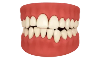 Caso de maloclusión corregible con alineadores Invisalign en Madrid