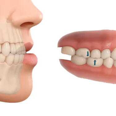 Dientes desalineados con desgaste leve; la maloclusión favorece el bruxismo