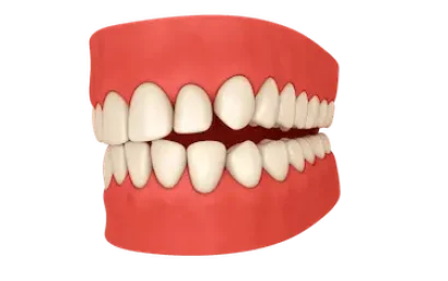 Ejemplo de mordida cruzada solucionada con alineadores Invisalign en Madrid