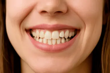 Ortodoncia metálica eficaz para corregir dientes torcidos en una boca con apiñamiento