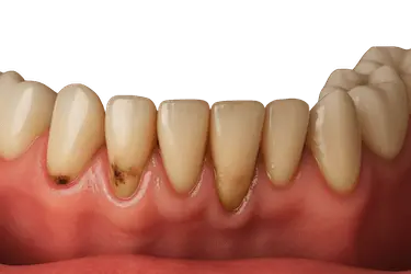 Dentadura con placa y sarro acumulado que provoca inflamación y mal sabor de boca