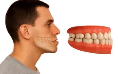 Prognatismo corregido con Invisalign en Madrid, caso clínico de ortodoncia invisible