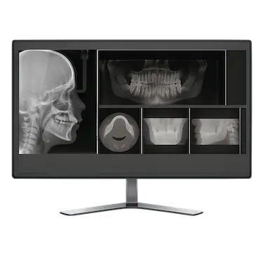 Radiografía para el diagnóstico y planificación de un tratamiento de ortodoncia con Invisalign