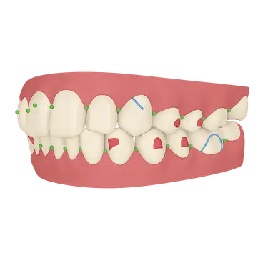 Refinamiento Invisalign con alineadores adicionales para corregir los últimos movimientos dentales