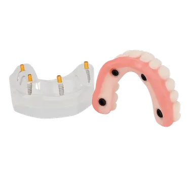 Técnica All-on-4 de carga inmediata con implantes dentales y prótesis completa inferior