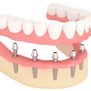 Implantes dentales All-on-6 con carga inmediata en la mandíbula inferior y prótesis fija completa