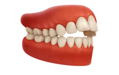 Mordida abierta anterior tratable con Invisalign en la clínica del Dr. Ferrer en Madrid