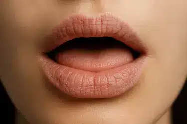 Boca seca o xerostomía que aumenta el riesgo de caries dentales