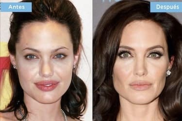 Antes y después del tratamiento de bolas de Bichat con cambio en el contorno facial