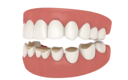 Desgaste dental por bruxismo tratado en la Clínica Dental Dr. Ferrer en Madrid