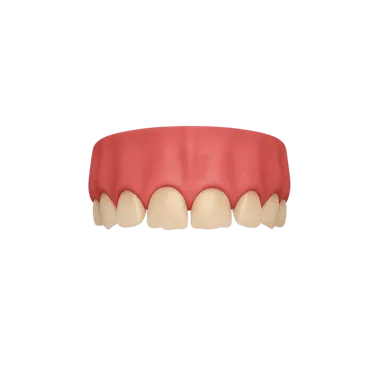 Desgaste dental severo por bruxismo grave con dientes acortados y esmalte dañado