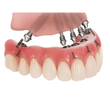 Prótesis superior con carga inmediata sobre implantes inclinados mediante la técnica All-on-6