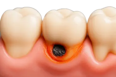 Caries de cuello dental en la unión del diente con la encía, lesión cercana al margen gingival