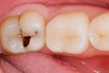 Primer plano de diente con caries que causa mal sabor de boca y necesita empaste