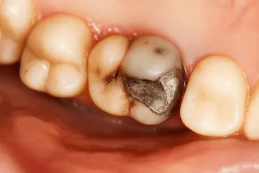 Caries visible en la superficie masticatoria de un molar con afectación de la corona