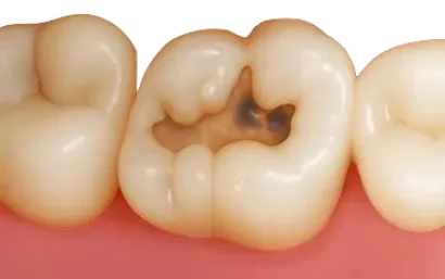 Caries dental avanzada en un molar con zona oscura visible en el esmalte.