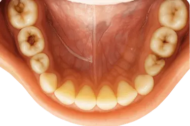 Caries oclusal en la superficie de masticación con mancha oscura en la fisura dental