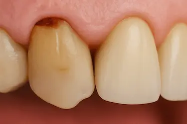 Caries radicular en la raíz dental junto a la encía, lesión cercana al margen gingival