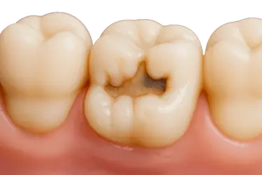 Caries recurrente alrededor de un empaste deteriorado en un diente tratado previamente