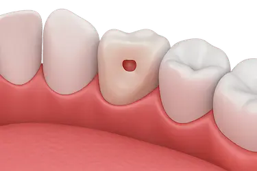 Agujero visible en el diente causado por caries avanzada y pérdida de estructura dental
