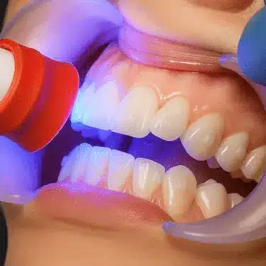 Colocación de ataches Invisalign durante tratamiento de ortodoncia invisible en Madrid