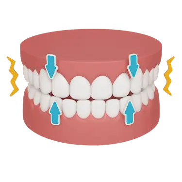 Ilustración 3D del bruxismo céntrico con apretamiento dental y sobrecarga mandibular
