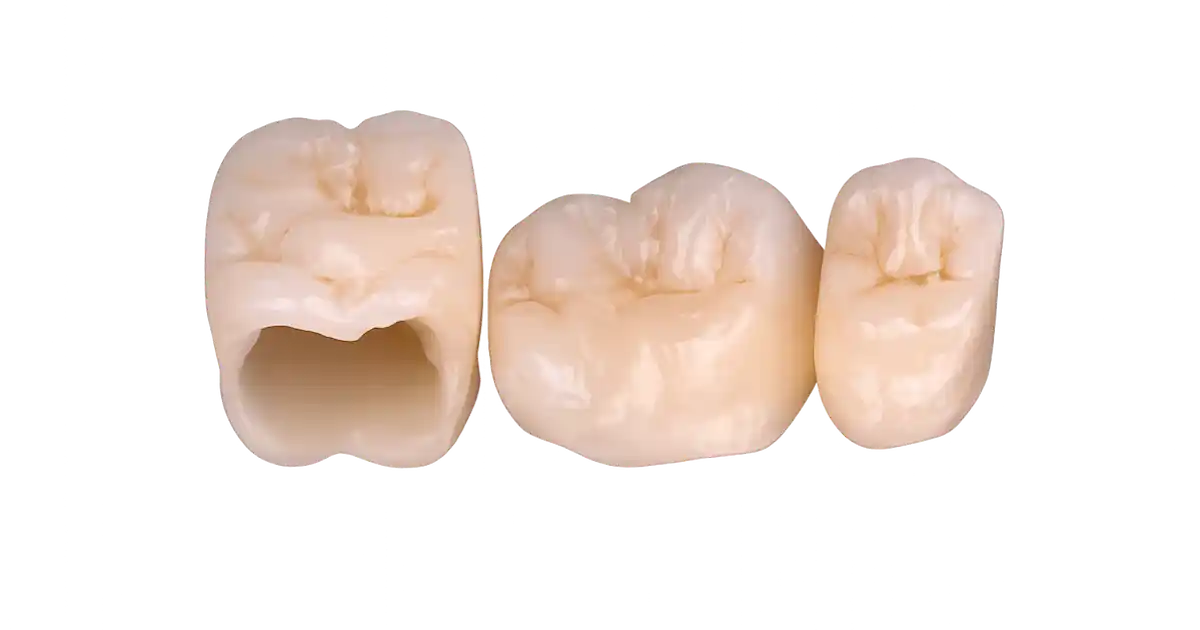 Colocación de una corona dental sobre diente tallado con encía rosada y dientes blancos en arcada inferior