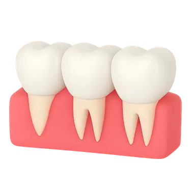 Corona dental colocada sobre diente natural tallado junto a dientes sanos