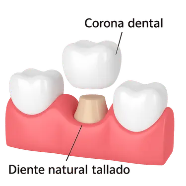 Ilustración de corona dental colocándose sobre diente natural tallado tras caries o fractura