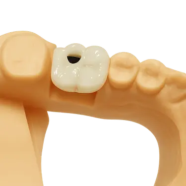 Corona dental atornillada colocada sobre diente perdido