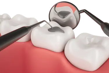 Empaste dental de resina composite para tratar una caries superficial