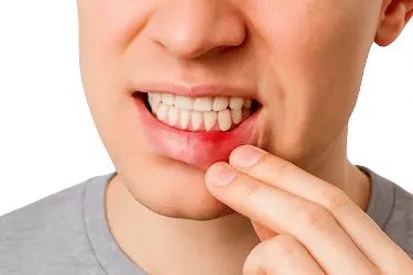 Inflamación de encías que puede provocar sensibilidad dental y molestias al comer o beber