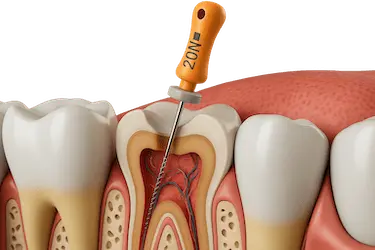 Endodoncia para tratar una caries profunda que afecta la pulpa dental