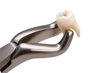 Extracción dental por caries avanzada que ha destruido el diente y provoca dolor