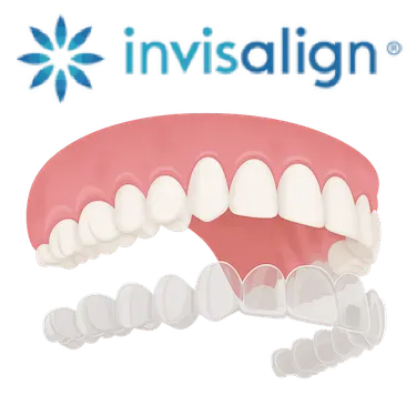 Simulación 3D de alineador Invisalign transparente sobre dientes para ortodoncia invisible