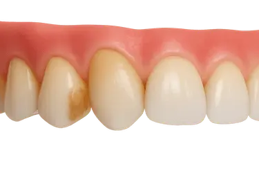 Manchas blancas o marrones en el esmalte como signo inicial de caries dental