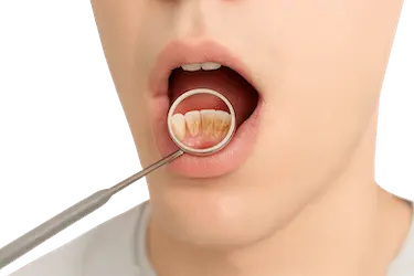 Acumulación de placa dental que puede causar sensibilidad y molestias en los dientes