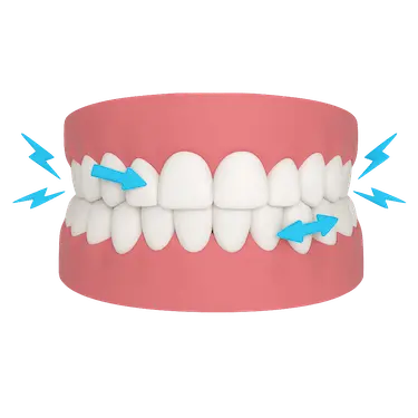 Modelo 3D del bruxismo excéntrico con rechinamiento lateral y desgaste dental