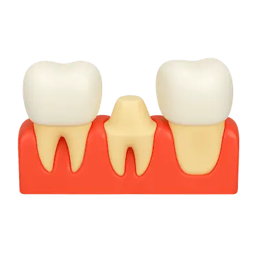 Modelo 3D del tallado de un diente natural previo a la colocación de una corona dental