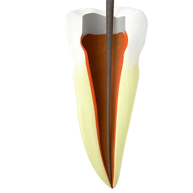 Diente abierto para acceder al nervio y limpiar los conductos durante una endodoncia en Madrid