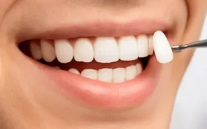 Prueba de color de carillas dentales superpuestas antes de su colocación definitiva