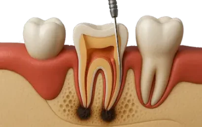 Ilustración 3D de endodoncia dental con tratamiento de conductos en Madrid por el Dr. Ferrer